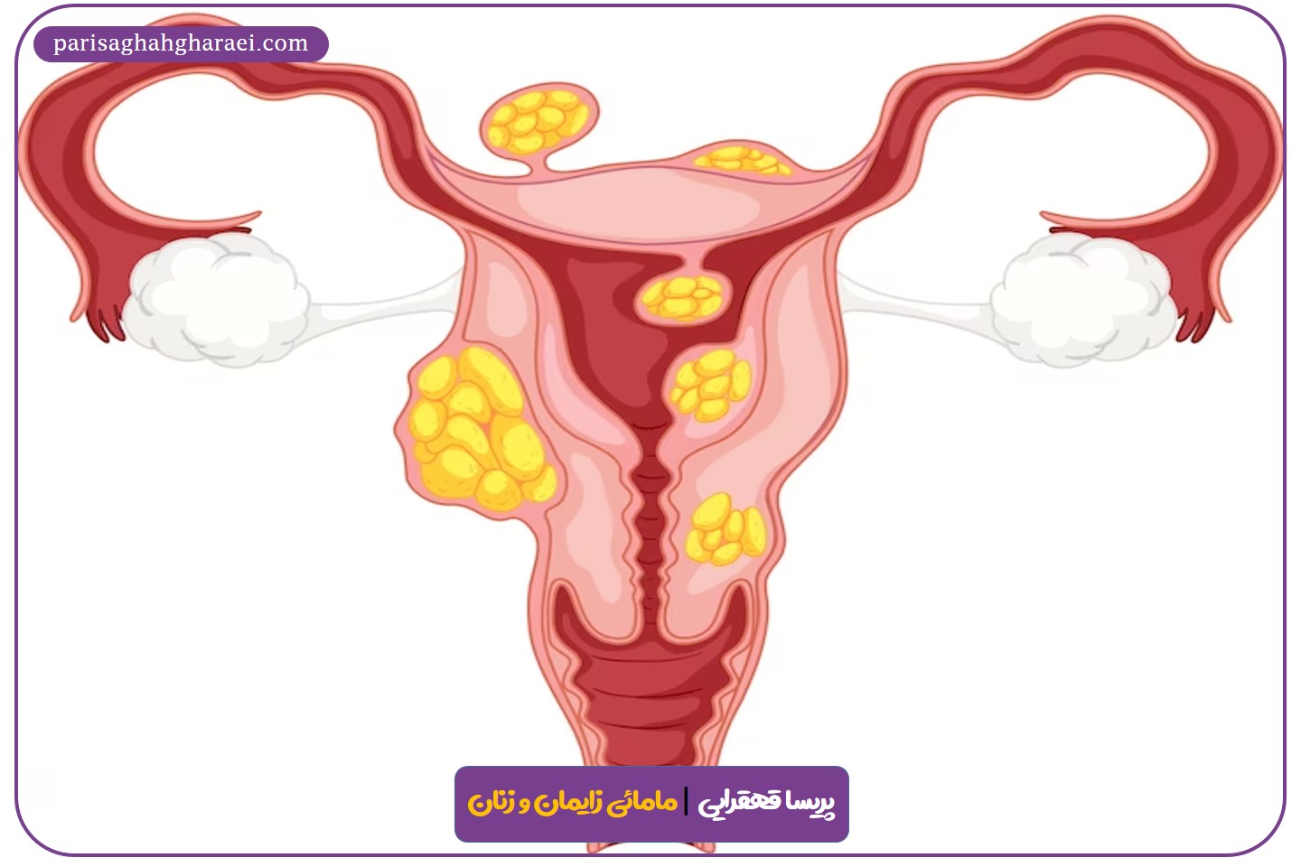 انواع کیست تخمدان
